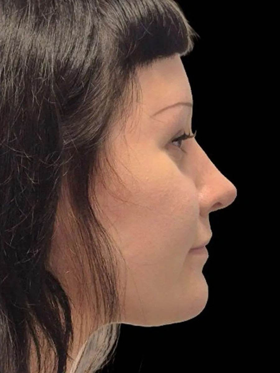 Poslije rinoplastike