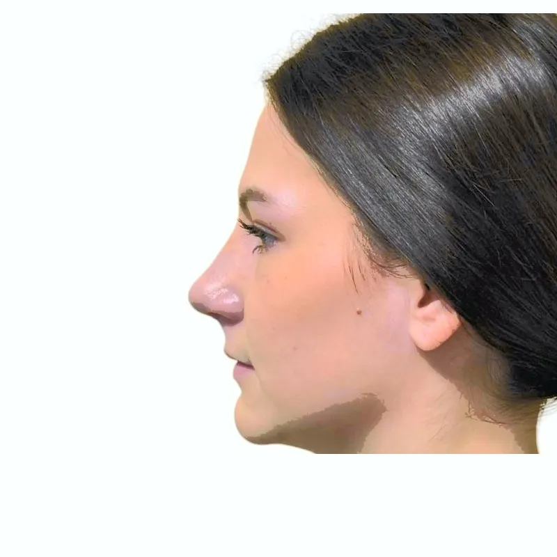 Poslije rinoplastike