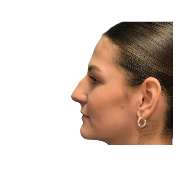 Prije rinoplastike