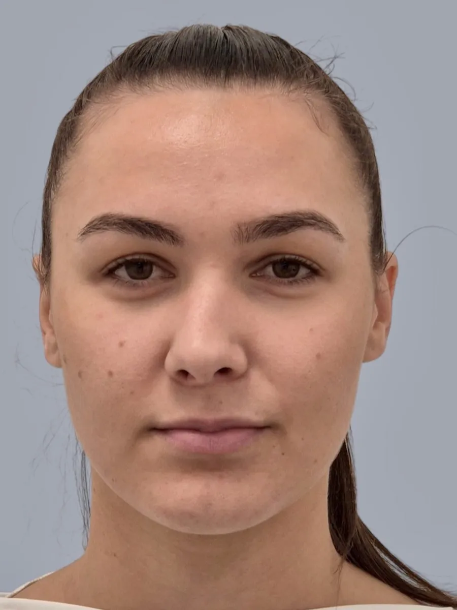 Prije rinoplastike