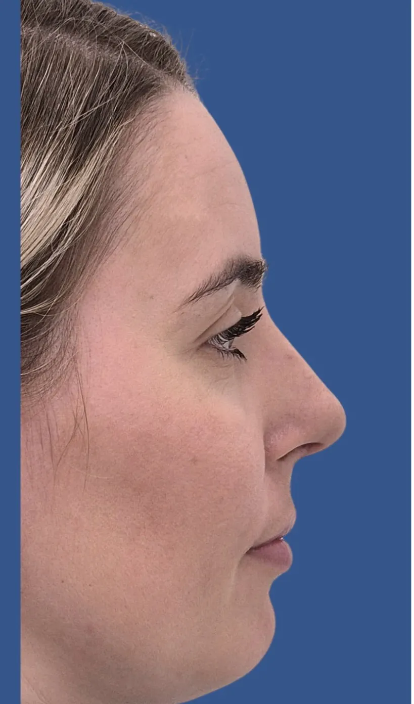 Poslije rinoplastike
